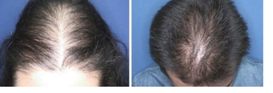 An Bras Dermatol：儿童雄激素性脱发：23例患者的临床特征、激素测定和代谢综合征危险因素的回顾性回顾