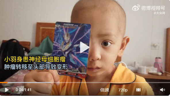 5岁男童患癌头部变形吓哭自己，3次手术2次移植再复发