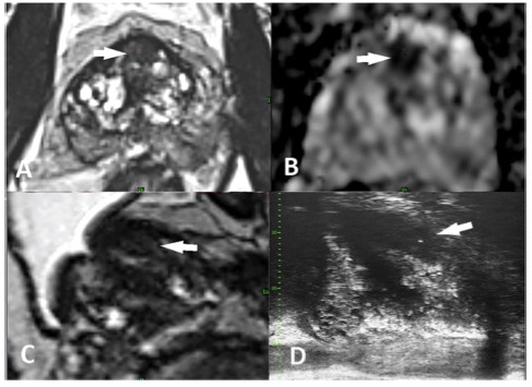 European Radiology：前列腺MRI在经直肠显微超声活检指导中的应用