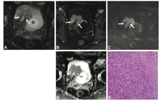 Radiology：输尿管口<font color="red">膀胱</font>肿瘤的多参数MRI评价
