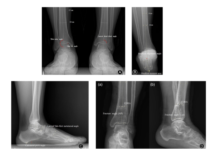 Orthop Surg：标准钢板与髓内钉治疗胫骨远端骨折的<font color="red">放射学</font>和临床疗效比较
