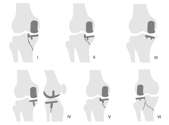 Knee Surg Sports Traumatol Arthrosc：非骨<font color="red">水泥</font>型和骨<font color="red">水泥</font>型单室膝关节置换术中假体周围胫骨骨折发生率的比较