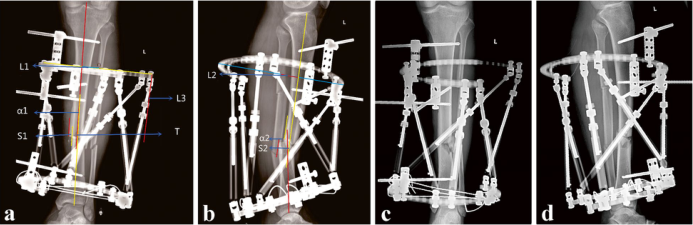 BMC Musculoskelet Disord：应用Taylor空间框架治疗胫骨骨折的标记物-三维测量与<font color="red">传统</font>X线测量