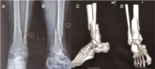 Front Surg：新型逆行髓内钉治疗胫骨远端骨折@MedSci