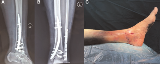 Front Surg：新型逆行髓内钉治疗胫骨远端骨折