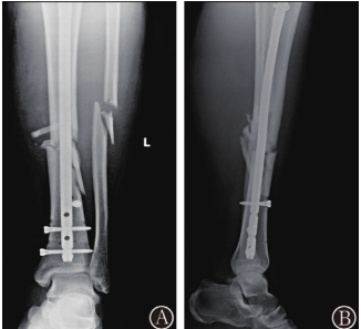 Orthop Surg：交锁髓内钉内<font color="red">固定</font>治疗<font color="red">胫骨</font>骨折术中识别<font color="red">胫骨</font>远端冠状面畸形的回顾性研究