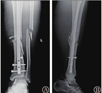 Orthop Surg：<font color="red">交</font>锁髓内钉内固定治疗胫骨骨折术中识别胫骨远端冠状面畸形的回顾性研究