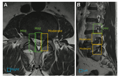 Radiology：利用深度学习提高放射科医生的腰椎MRI报告判析生产力！