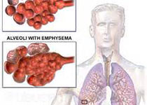 1例皮疽诺卡菌引起的肺部感染