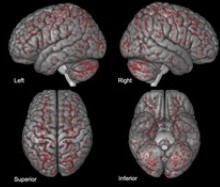 Stroke：主动脉弓手术后脑MRI所示新缺血性脑病变的频率和<font color="red">分布</font>