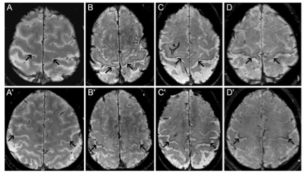 European Radiology：铁敏感MRI在鉴别遗传性痉挛性截瘫与其他运动神经元疾病中的应用。