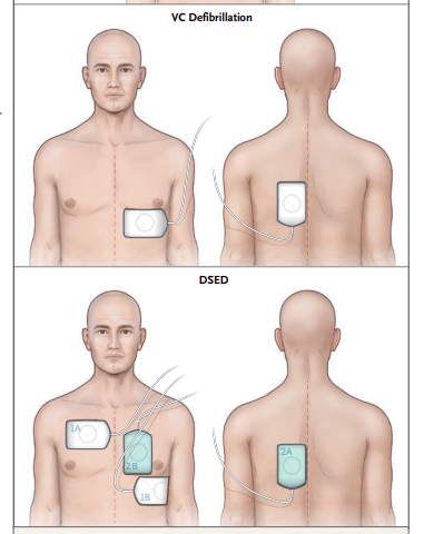 NEJM：双向波<font color="red">除</font><font color="red">颤</font>（DSD）和向量变化（VC）<font color="red">除</font><font color="red">颤</font>用于治疗顽固性室颤