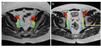 European Radiology：作为影像科医师，在面对局部进展期直肠癌患者的MR图像时，这一点你是否会关注？