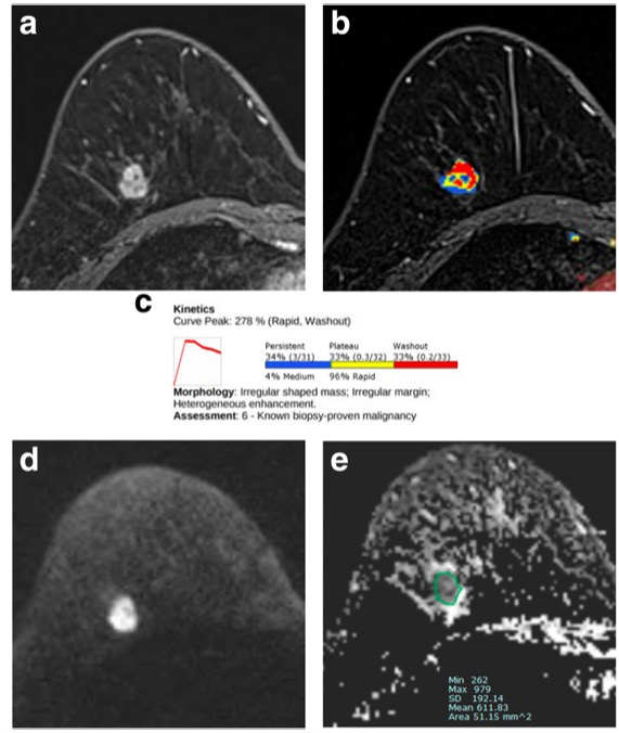 无需手术的乳腺癌亚型分析-DCE和DWI MRI的定量评估