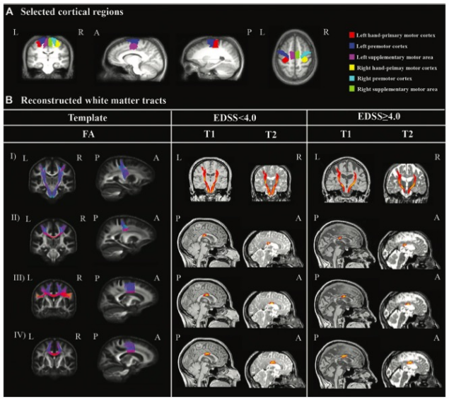 Radiology：胼胝体MRI在预测<font color="red">MS</font>运动障碍中的价值