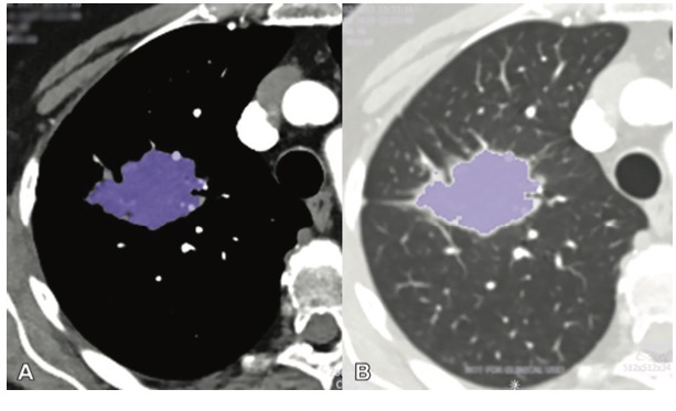 Radiology：双能量CT灌注，让影像学冲在非小细胞肺癌评估的最前线！