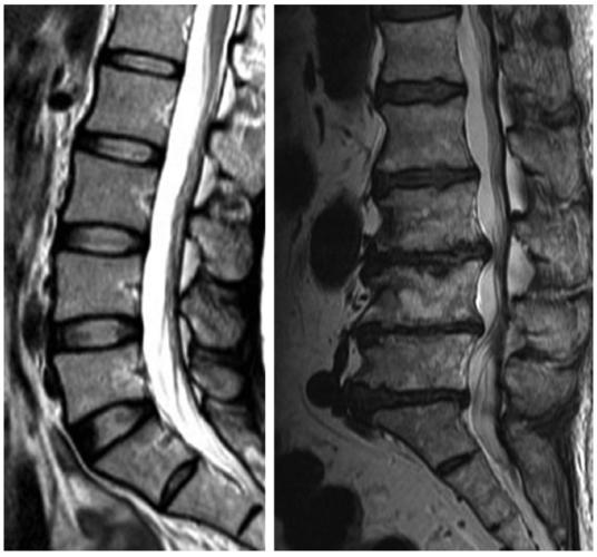 SPINE: 腰椎<font color="red">MRI</font>退行性表现与下腰痛关系不大
