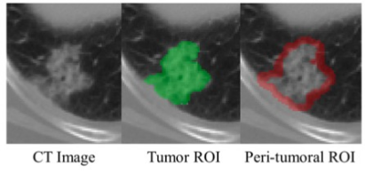 European Radiology：放射组学特征对肺腺癌患者预后预测的附加<font color="red">价值</font>
