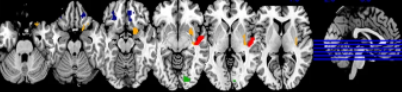 Nature子刊：多模态神经影像学预测重度抑郁症患者非自杀性自伤的脑环路