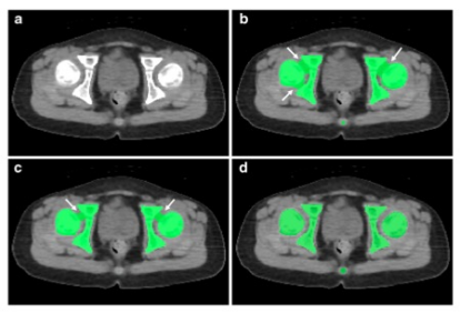 European Radiology：利用深度神经网络实现儿科患者全身CT图像的身体成分全自动分析