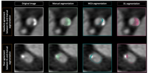 European Radiology：基于深度学习的冠状动脉粥样硬化斑块分割在CCTA上的应用