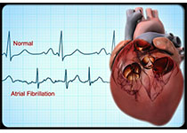 Eur Heart J：骨形态发生蛋白10-房颤患者缺血性卒中新的风险标记物