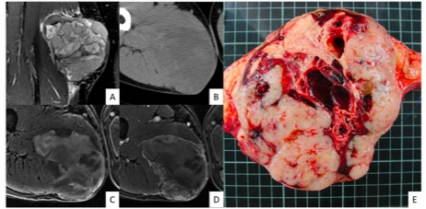 European Radiology：四肢滑膜肉瘤的影像学预后因素