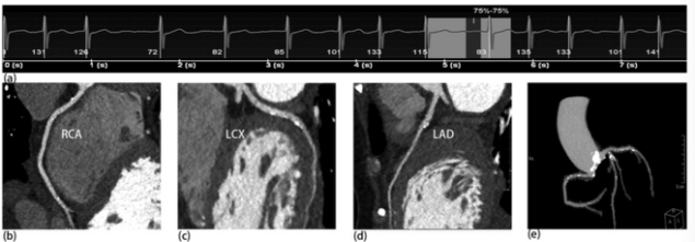 European Radiology：使用全心脏覆盖CT扫描仪评估心房颤动患者<font color="red">TAVI</font>术后的图像质量和诊断性能