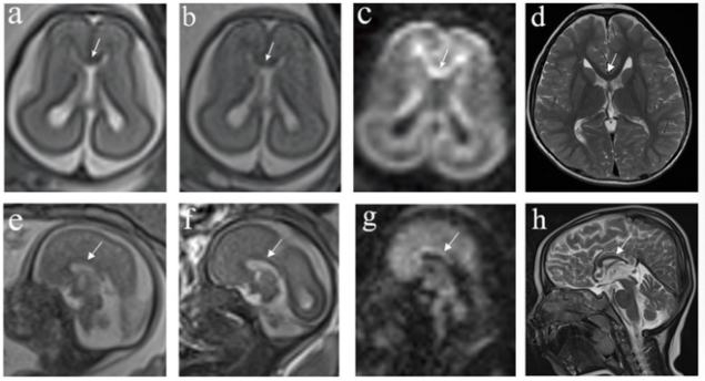 European Radiology：这一序列，让胎儿胼胝体MRI充满可能！