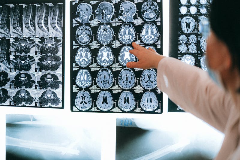 Radiology：弥散张量磁共振成像显示快速眼动睡眠行为障碍患者大脑淋巴循环改变