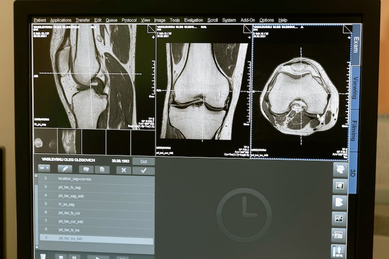 影像诊断 | 不可忽视的膝关节内侧疼痛原因：鹅足滑囊炎！