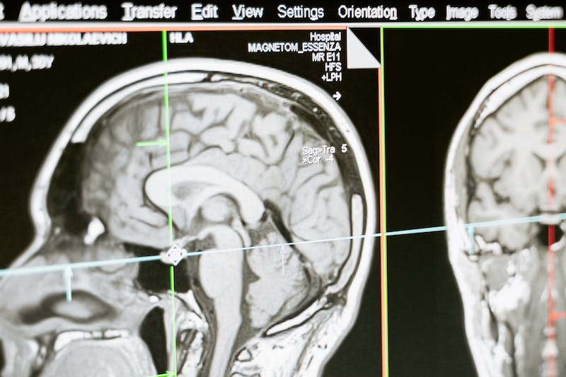 Radiology：脑缺血组织结构变化的体内<font color="red">弥散</font>加权MR评估