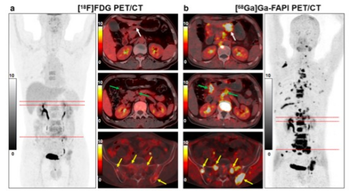 European Radiology：胃印戒细胞癌患者[68Ga]Ga-FAPI和[18F]FDG的摄取比较