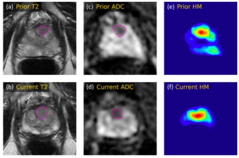 European Radiology：<font color="red">人工智能</font><font color="red">辅助</font>双参数MRI的前列腺癌监测