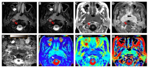 European Radiology：MRI在鉴别良性和转移性<font color="red">咽</font><font color="red">后</font>淋巴结中的应用