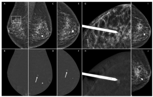 European Radiology：增强乳腺钼靶引导下活检技术的临床价值及应用