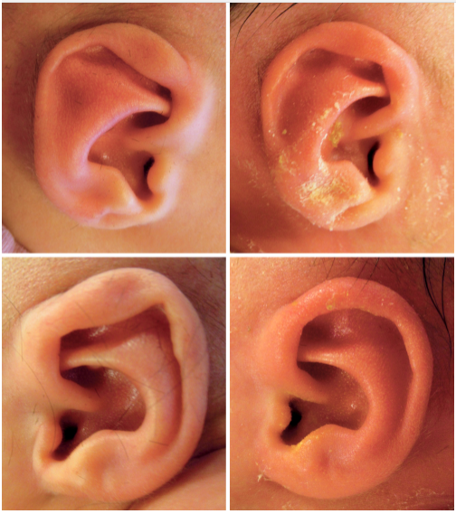 PRS：婴幼儿耳畸形非手术治疗的10年回顾