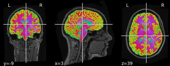 NeuroImage：一种适用于常规临床头部MRI检查的<font color="red">脑</font><font color="red">年龄</font>框架