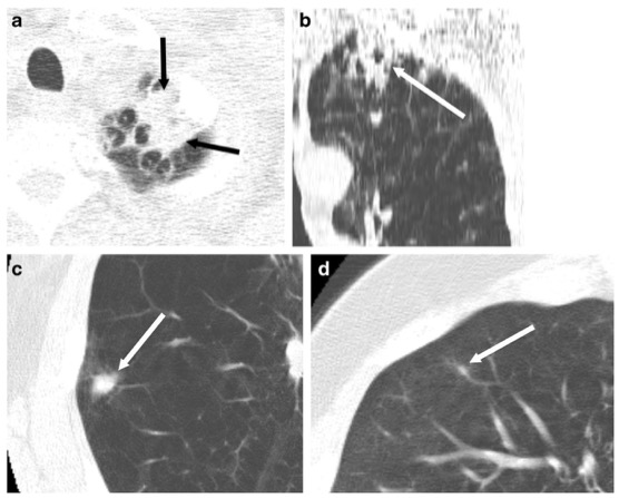 European Radiology:计算机辅助诊断在肺癌CT筛查中的Lung-RADS分类应用