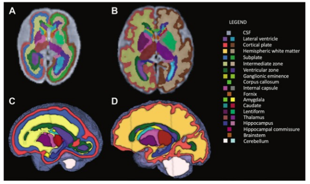 Radiology:胎儿<font color="red">脑</font>组织究竟如何<font color="red">发育</font>？MRI带你来看看