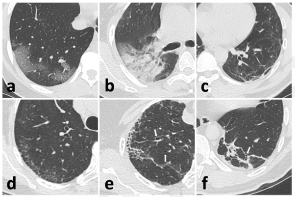 Radiology:COVID-19患者出院后，肺部病变的变化究竟预示着什么？