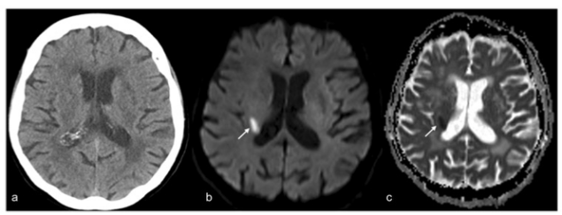 European Radiology:对于脑卒中患者来说，仅仅使用CT还远远<font color="red">不够</font>！