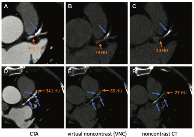Radiology:深度学习在冠状动脉CTA钙化评分的应用