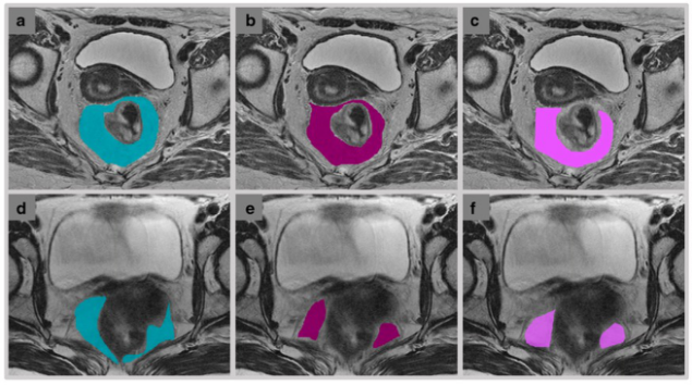 European Radiology：直肠系膜脂肪的MRI<font color="red">放射</font>组学特征与直肠癌患者的预后