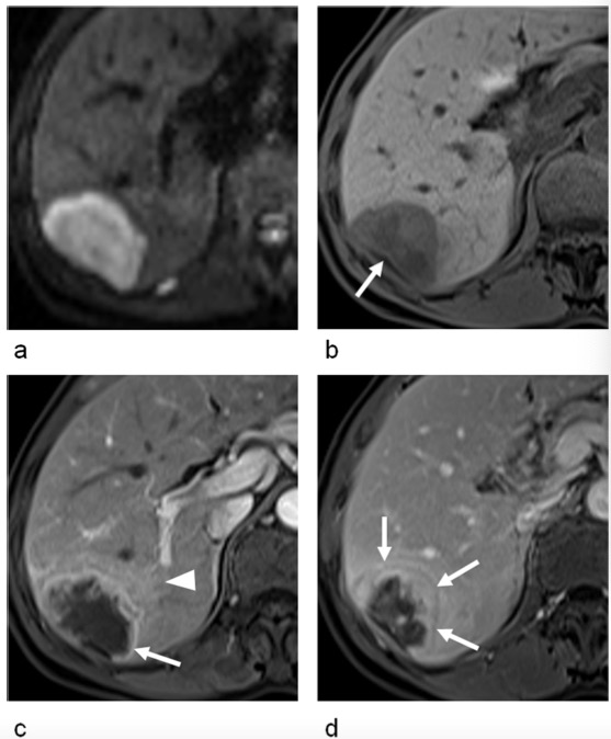 European Radiology：混合性肝细胞癌-胆管癌的这些MRI表现提示了预后！