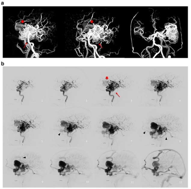 European Radiology:静音MRA为脑动静脉畸形的评估提供了新的<font color="red">指标</font>