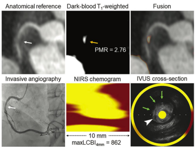 Radiology：MR上冠状动脉的高信号斑块究竟由什么组成？