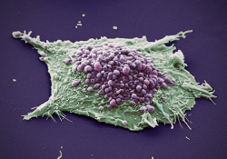 Cancers：多中心研究探索局部晚期 Merkel细胞癌的治疗、预后以及相关因素