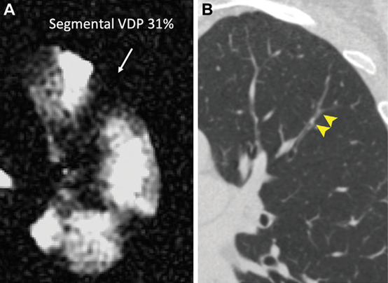 Radiology：CT和氦3 MRI发现黏液栓塞可能是哮喘通气缺陷的重要原因
