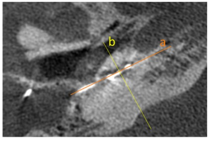 European Radiology：人工耳蜗植入术后乳突面神经管的影像学评估与面神经<font color="red">刺激</font>的相关性